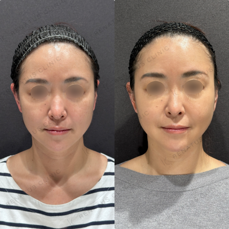 糸リフト症例写真