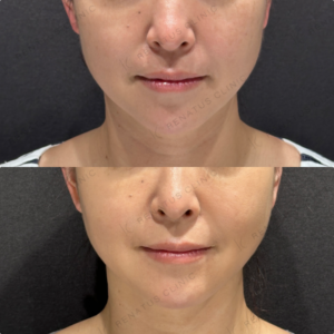 糸リフト症例写真の症例写真