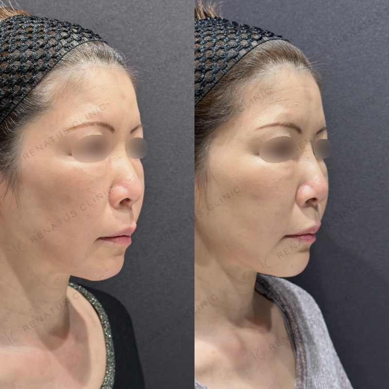 糸リフト頬ヒアルロン酸ボリフト症例写真