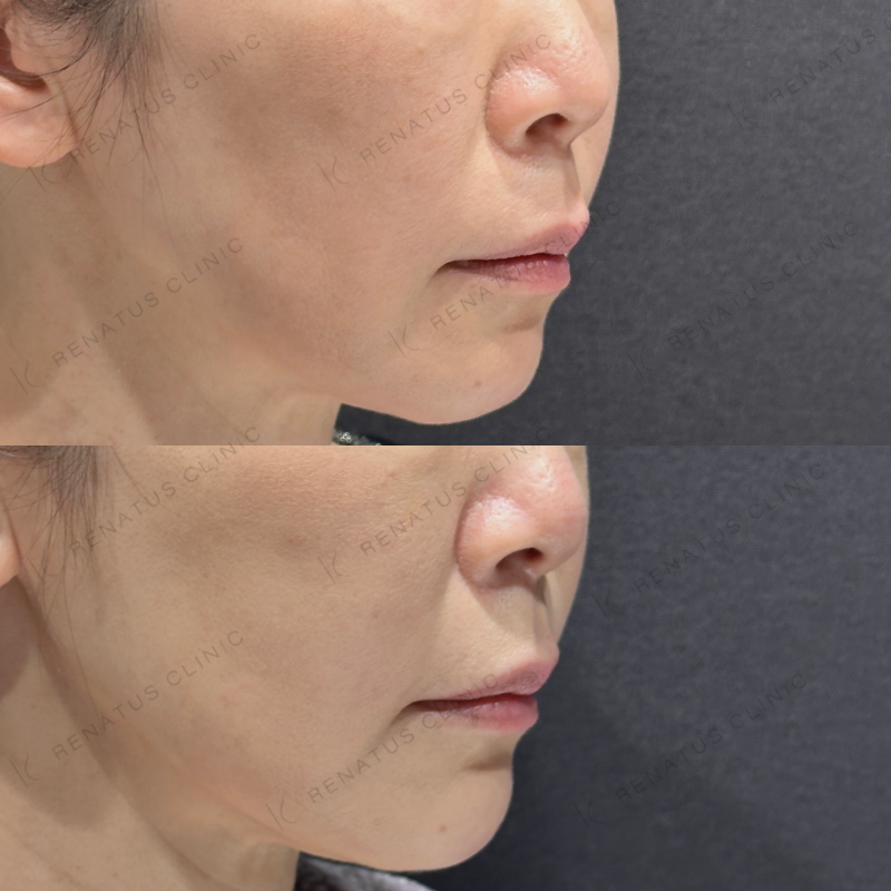 糸リフト頬ヒアルロン酸ボリフト症例写真