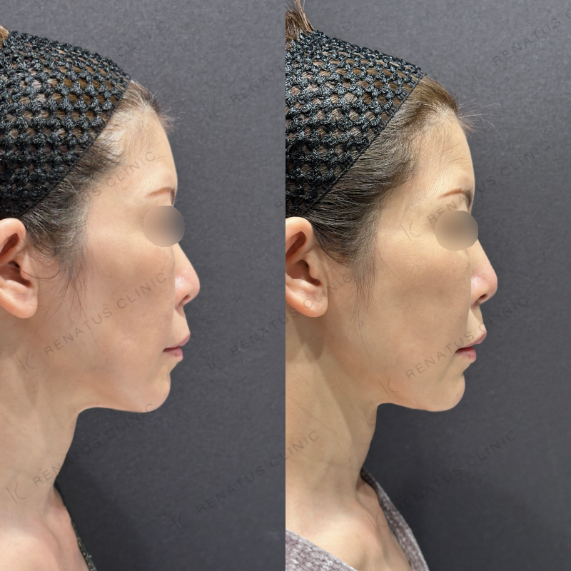 糸リフト頬ヒアルロン酸ボリフト症例写真