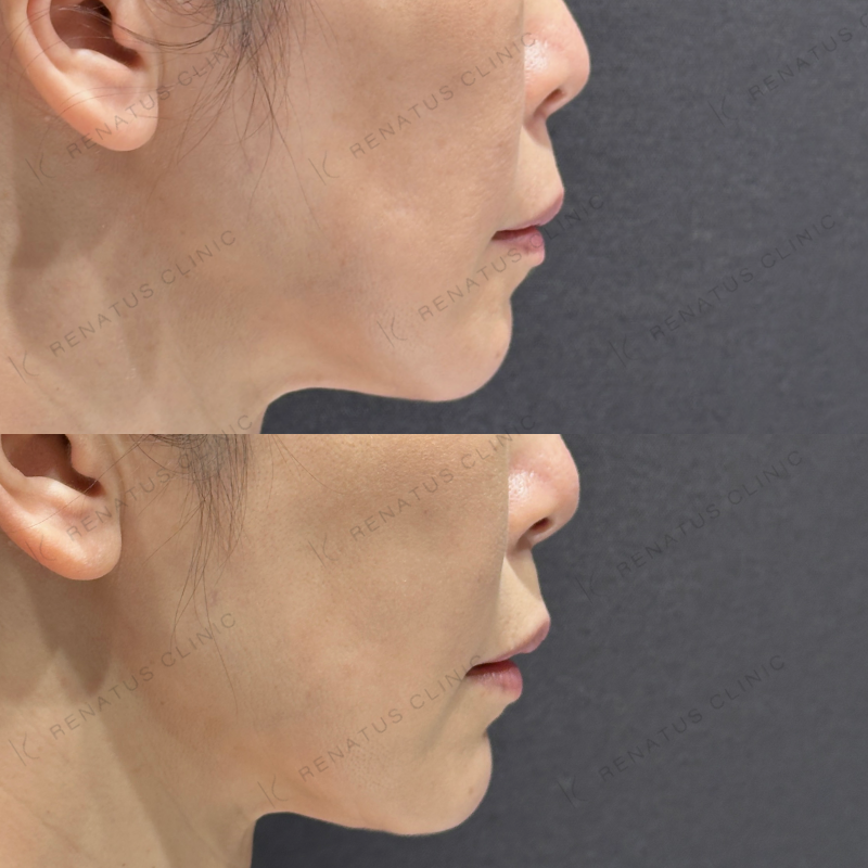 糸リフト頬ヒアルロン酸ボリフト症例写真