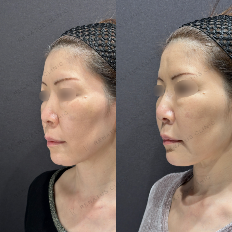 糸リフト頬ヒアルロン酸ボリフト症例写真