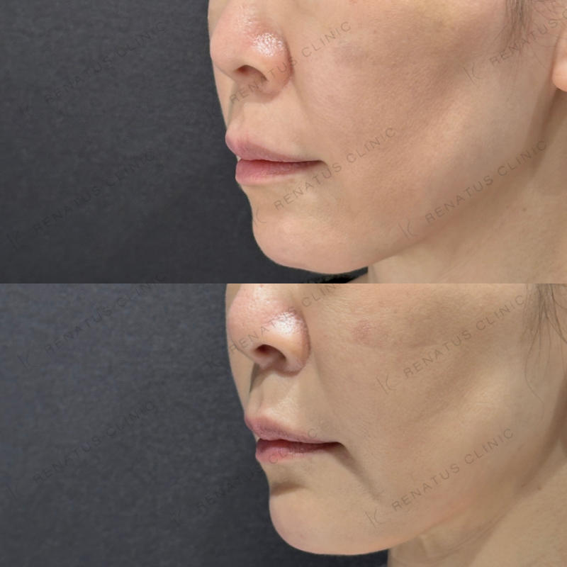 糸リフト頬ヒアルロン酸ボリフト症例写真