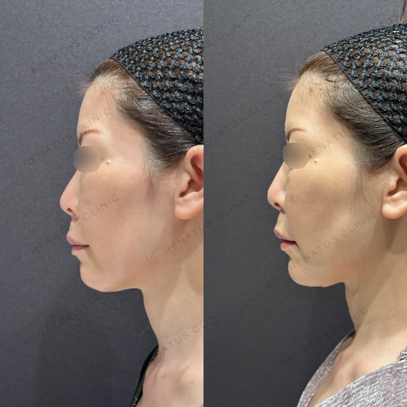 糸リフト頬ヒアルロン酸ボリフト症例写真