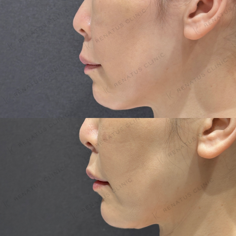 糸リフト頬ヒアルロン酸ボリフト症例写真