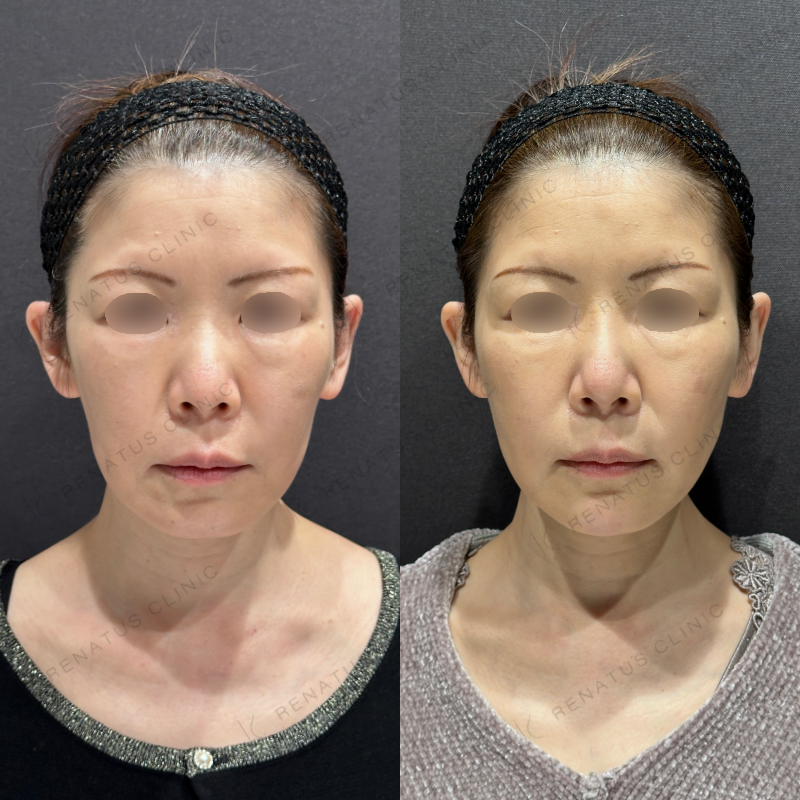 糸リフト頬ヒアルロン酸ボリフト症例写真