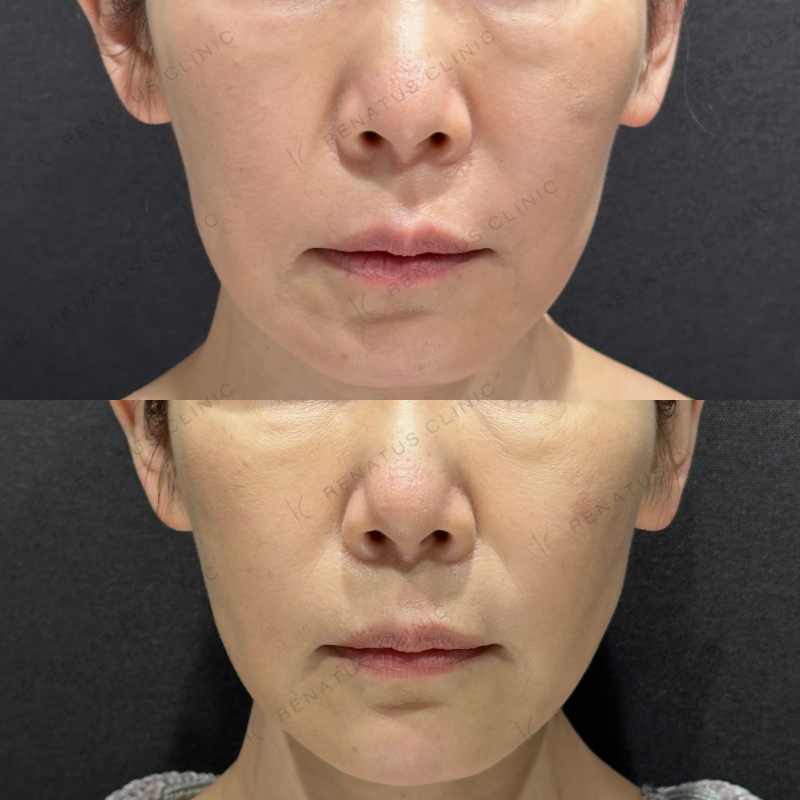 糸リフト頬ヒアルロン酸ボリフト症例写真