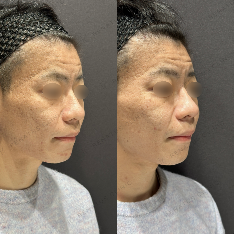 頬ヒアルロン酸ボライト症例写真