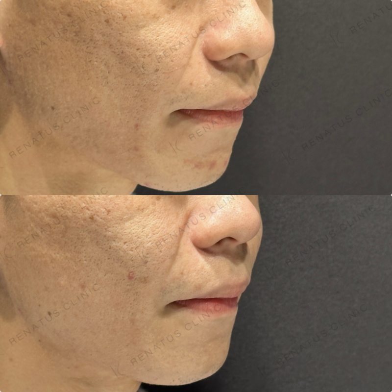 頬ヒアルロン酸ボライト症例写真