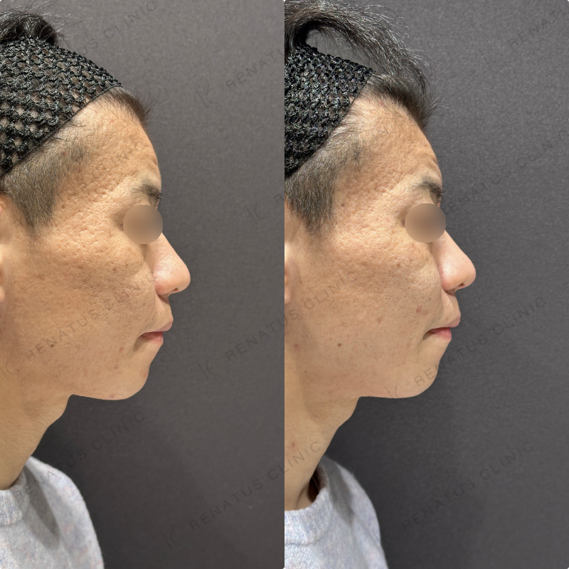 頬ヒアルロン酸ボライト症例写真