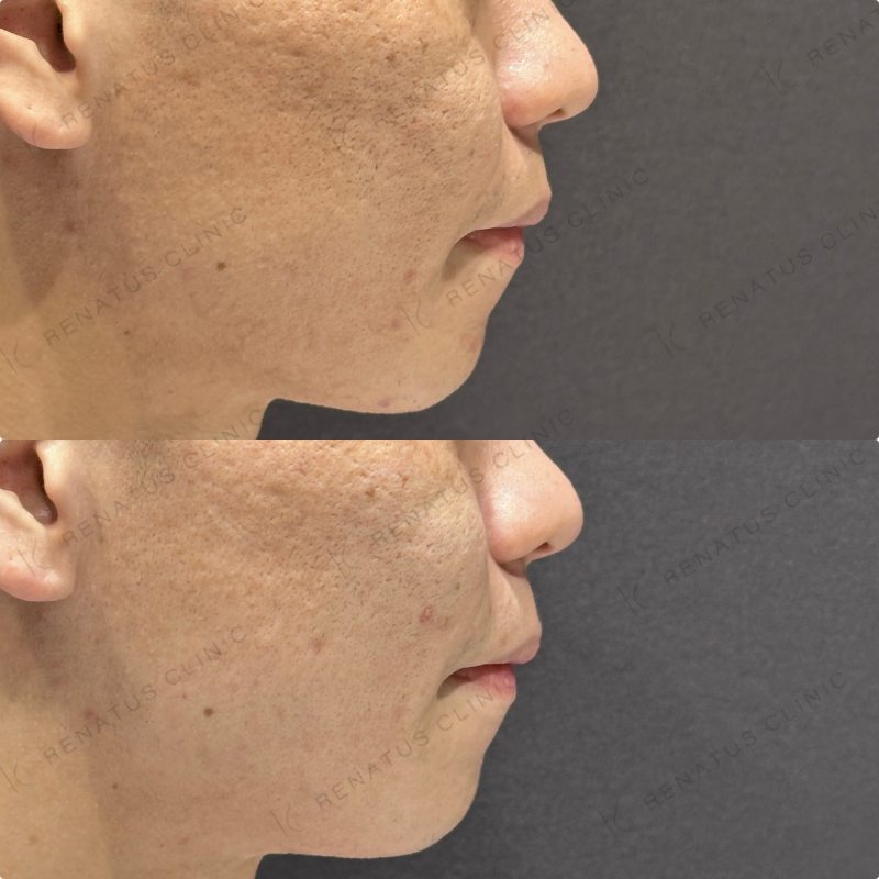 頬ヒアルロン酸ボライト症例写真