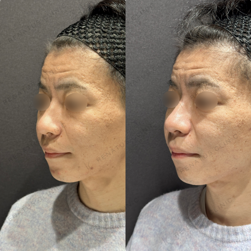 頬ヒアルロン酸ボライト症例写真