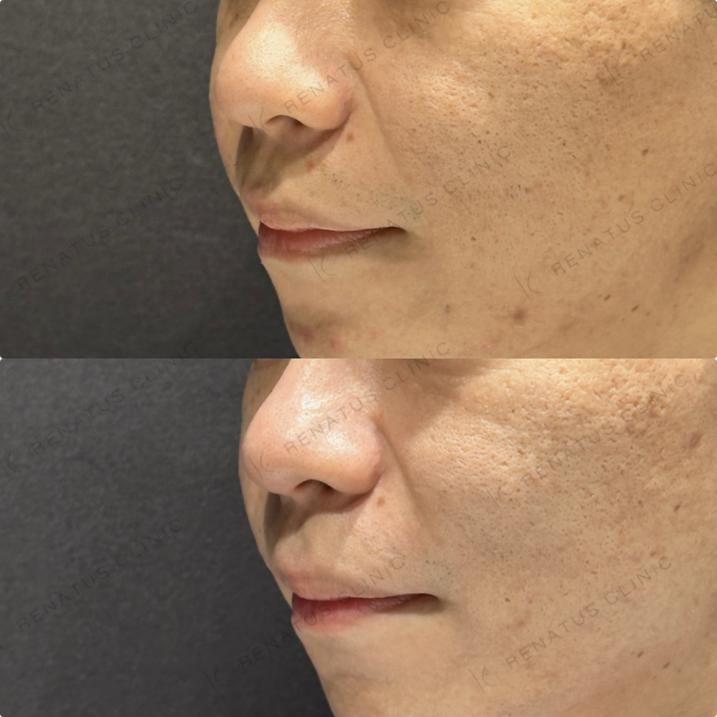 頬ヒアルロン酸ボライト症例写真