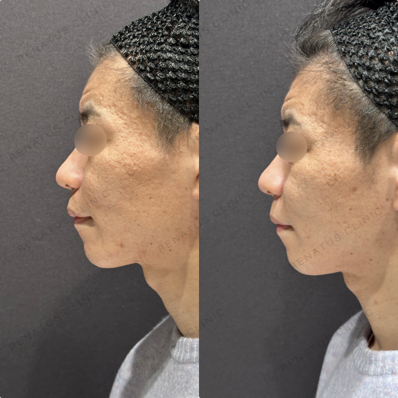 頬ヒアルロン酸ボライト症例写真