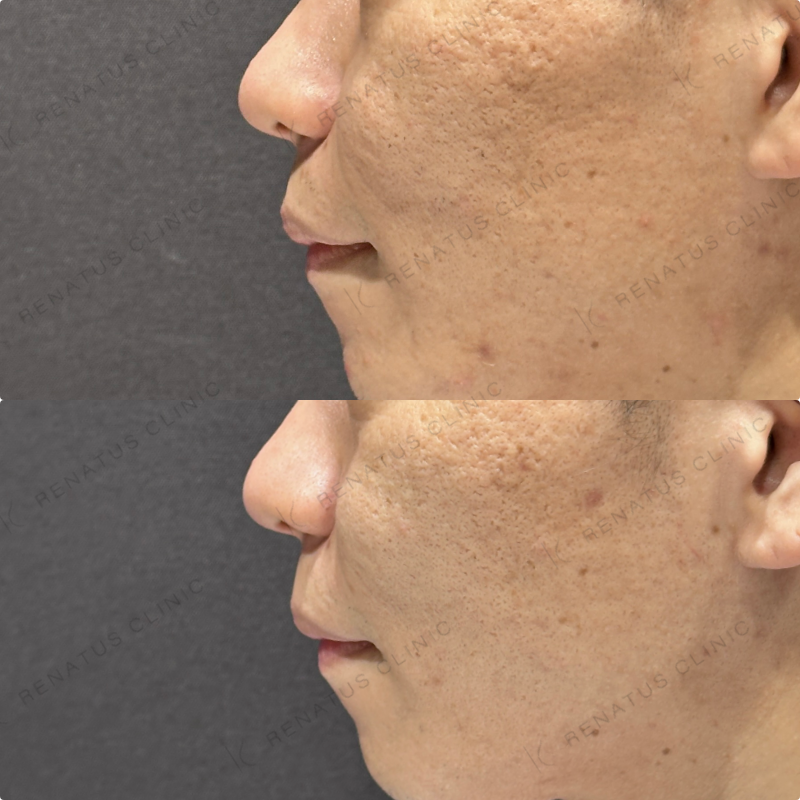 頬ヒアルロン酸ボライト症例写真