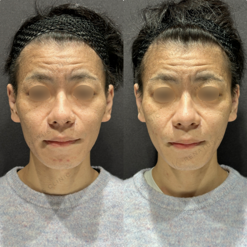 頬ヒアルロン酸ボライト症例写真