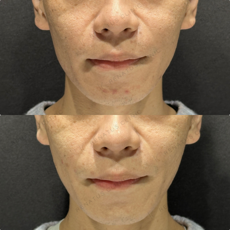 頬ヒアルロン酸ボライト症例写真