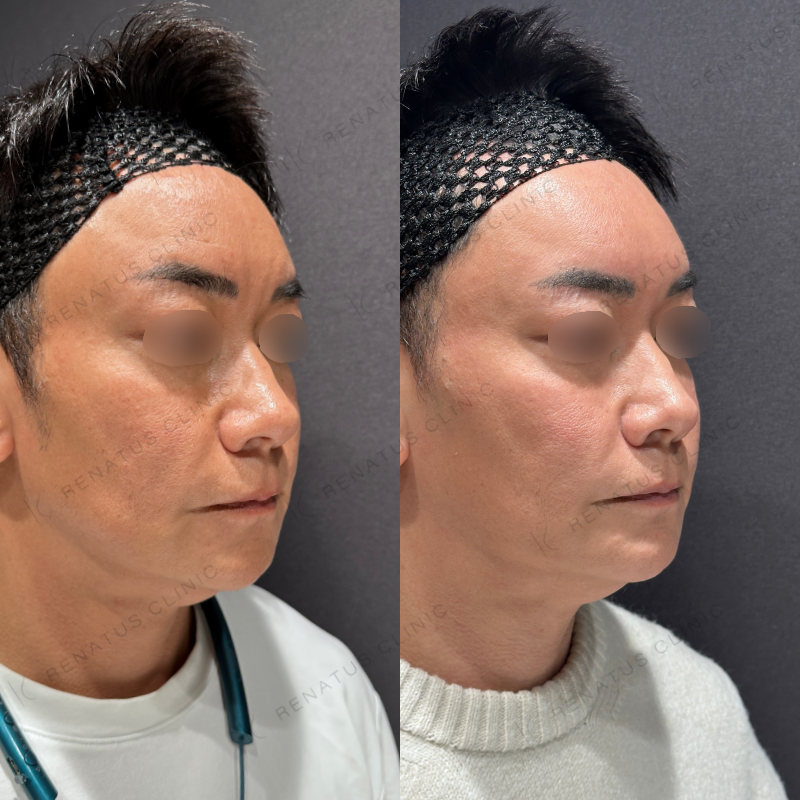 額こめかみヒアルロン酸ボリューマ症例写真