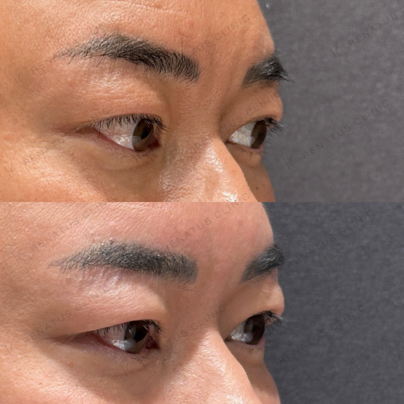 目の上ヒアルロン酸ボライト症例写真