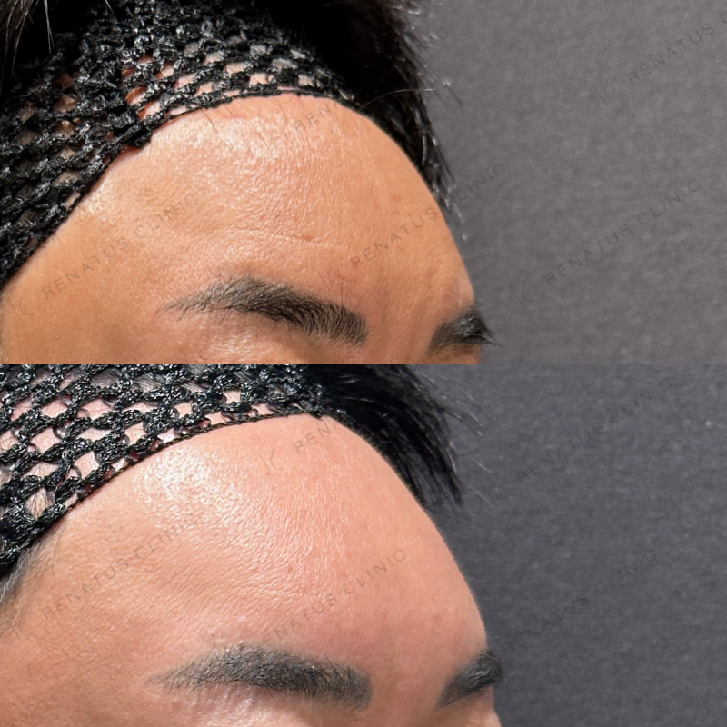 額こめかみヒアルロン酸ボリューマ症例写真