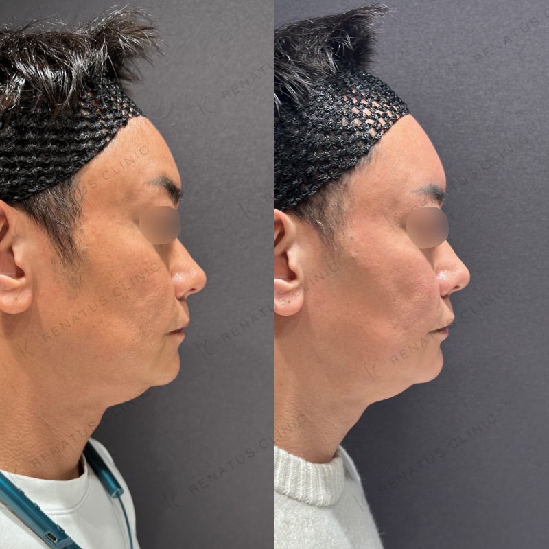 額こめかみヒアルロン酸ボリューマ症例写真