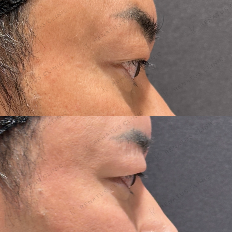 目の上ヒアルロン酸ボライト症例写真