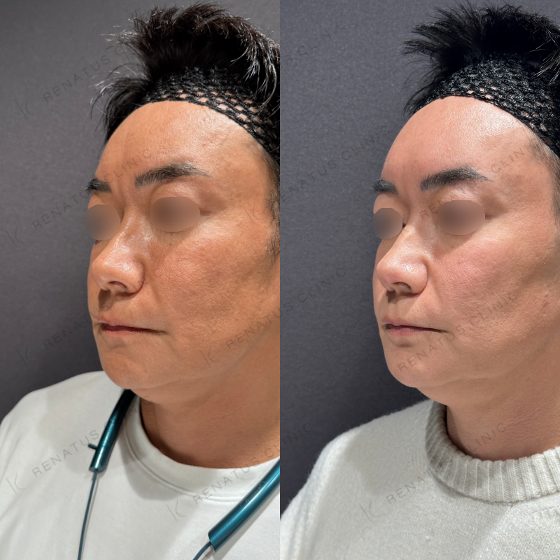 額こめかみヒアルロン酸ボリューマ症例写真