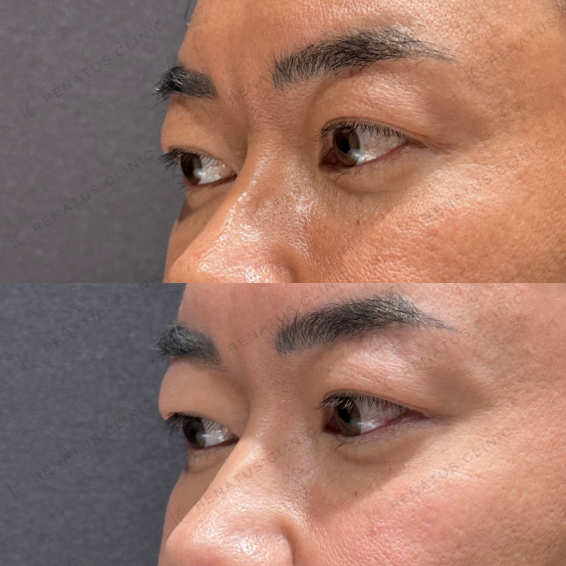 目の上ヒアルロン酸ボライト症例写真