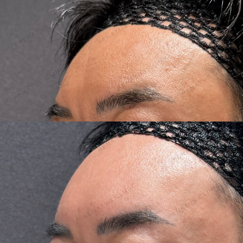 額こめかみヒアルロン酸ボリューマ症例写真