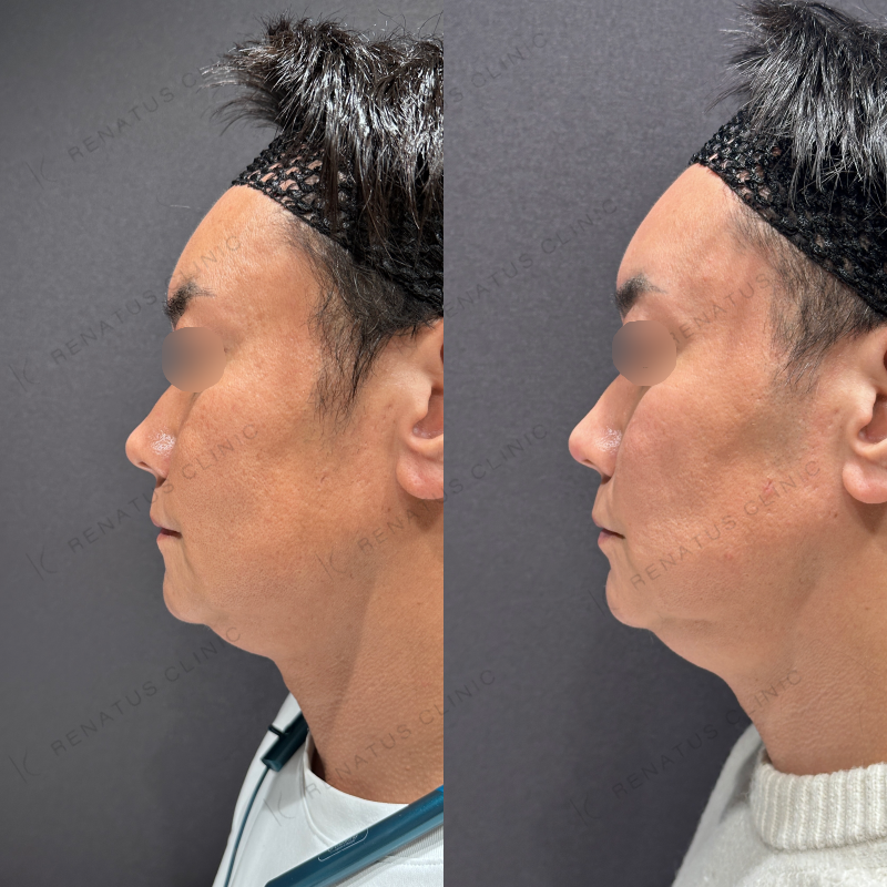 額こめかみヒアルロン酸ボリューマ症例写真