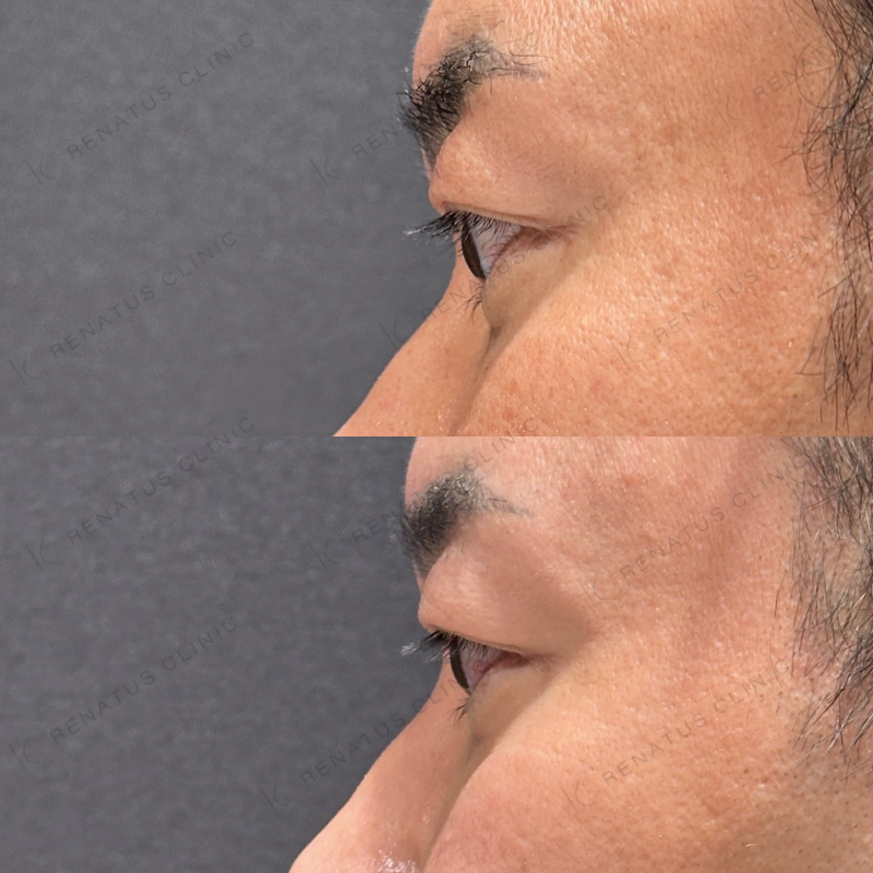 目の上ヒアルロン酸ボライト症例写真