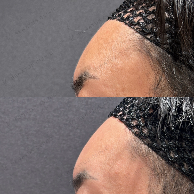 額こめかみヒアルロン酸ボリューマ症例写真