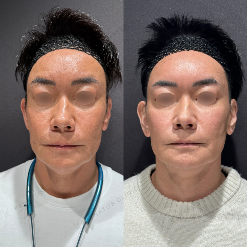 額こめかみヒアルロン酸ボリューマ症例写真