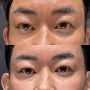 目の上ヒアルロン酸ボライト症例写真の症例写真