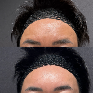 額こめかみヒアルロン酸ボリューマ症例写真の症例写真