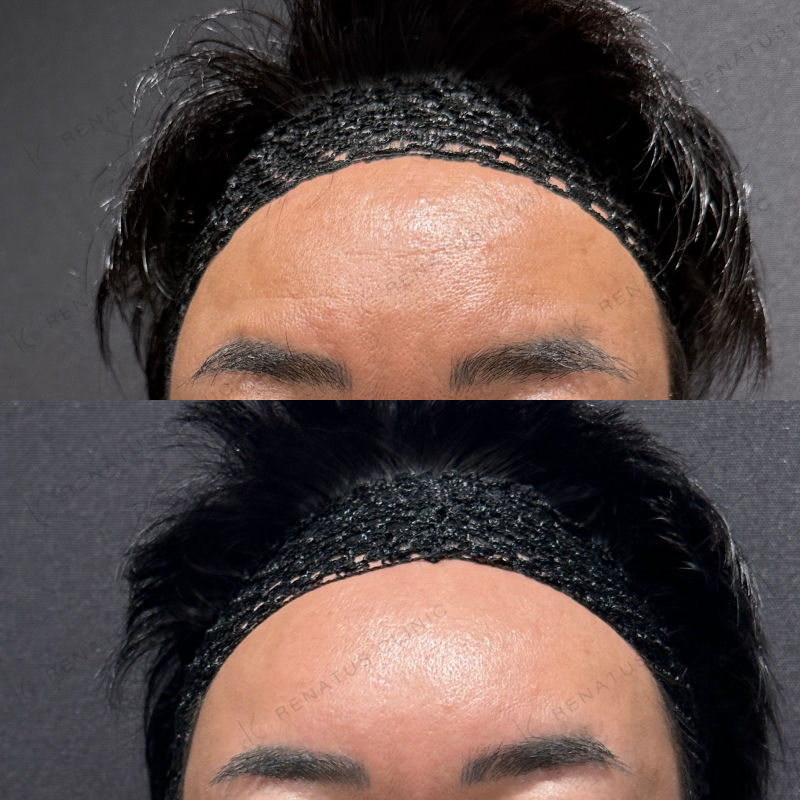 額こめかみヒアルロン酸ボリューマ症例写真