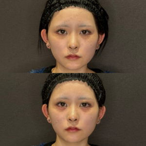 涙袋ヒアルロン酸症例写真｜レナトゥスクリニック　名古屋名駅で上手いヒアルロン酸治療の症例写真