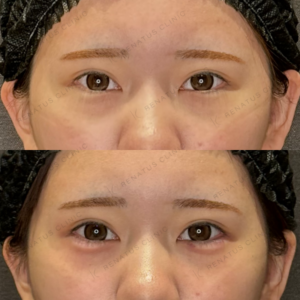 涙袋ヒアルロン酸症例写真｜レナトゥスクリニック　名古屋名駅　フィラーの名医の症例写真