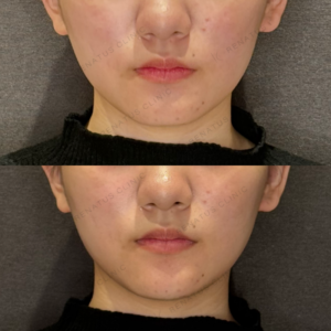 顎ヒアルロン酸症例写真｜レナトゥスクリニック　の症例写真
