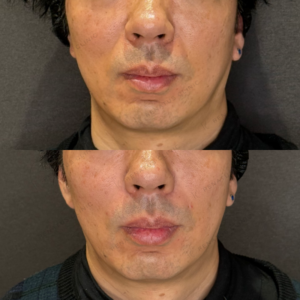 ほうれい線ヒアルロン酸症例写真｜名古屋で上手い安いヒアルロン酸ならレナクリの症例写真