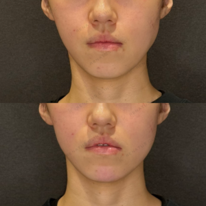 顎ヒアルロン酸症例写真｜名古屋で上手い安いヒアルロン酸ならレナトゥスクリニックの症例写真