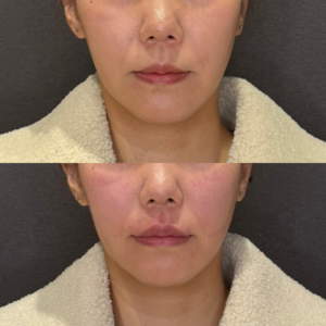 唇ヒアルロン酸症例写真｜レナトゥスクリニック　名古屋名駅で上手いヒアルロン酸の症例写真