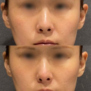 鼻ヒアルロン酸ボラックス症例写真の症例写真