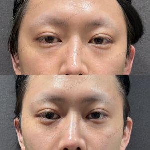 目の下のクマ取り症例写真の症例写真