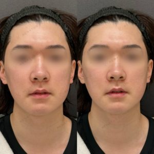 顎ヒアルロン酸ボラックス症例写真の症例写真