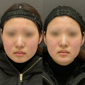 顎ヒアルロン酸ボラックス症例写真の症例写真