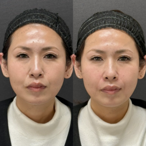 鼻翼基部・ほうれい線ヒアルロン酸ボリューマ症例写真の症例写真