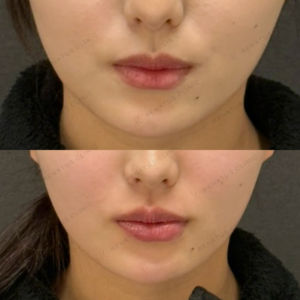 上唇・Cカール・下唇ヒアルロン酸ボルベラ症例写真の症例写真