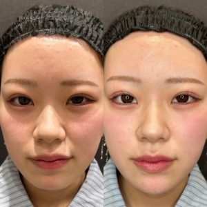 顎ヒアルロン酸ボラックス症例写真の症例写真